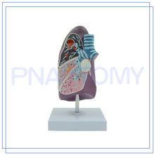 PNT-0732 qualitativ hochwertige kranke menschliche Lunge medizinisches Modell